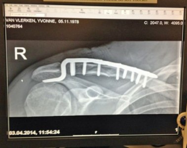 yvonne van vlerken collar bone